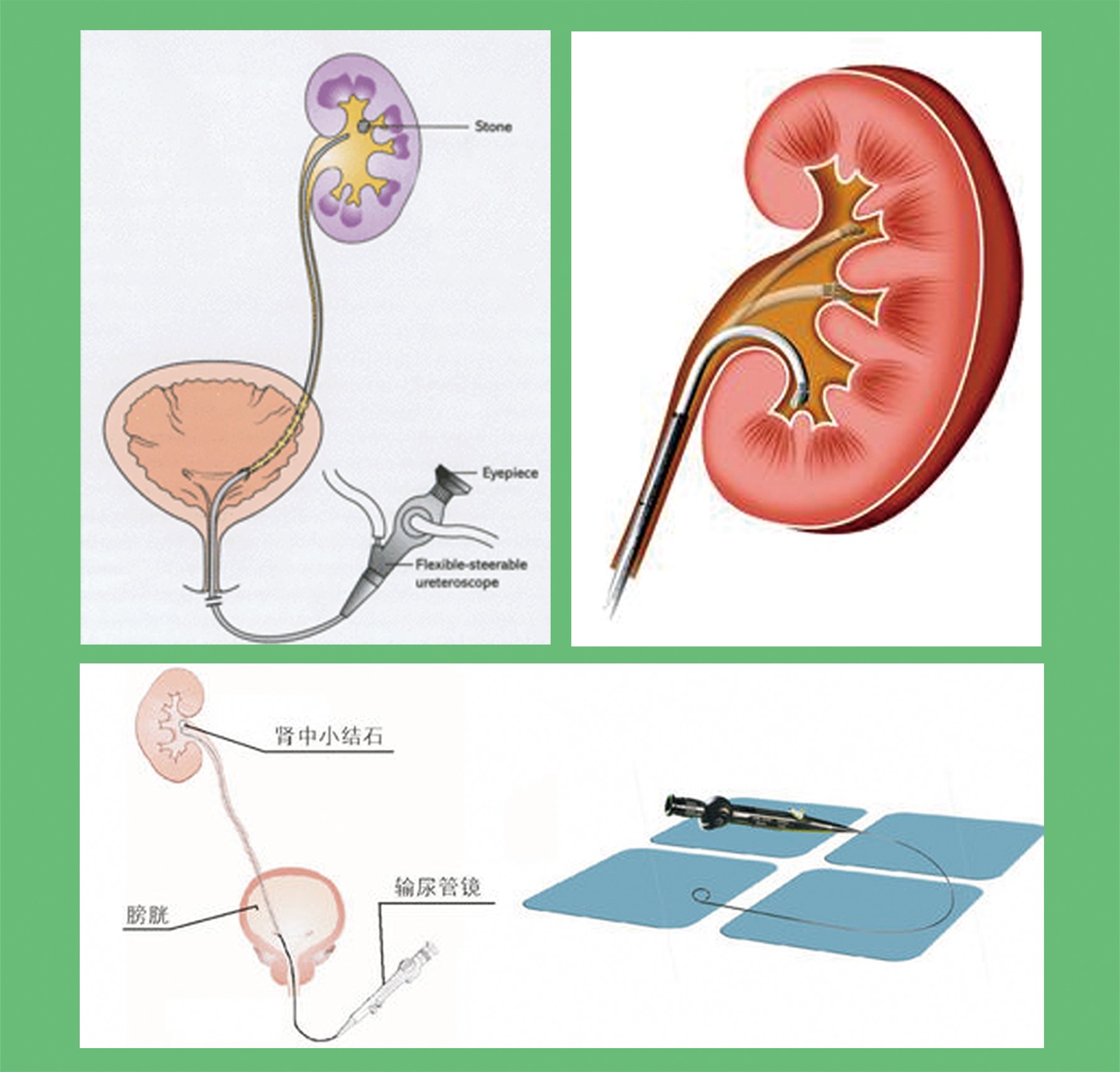 肾小球是肾脏内肾元的一部分，从左到右放大并平移。视频素材_ID:VCG42N855-112-VCG.COM